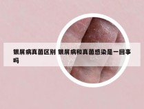 银屑病真菌区别 银屑病和真菌感染是一回事吗
