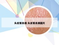 头皮银肖病 头皮银肖病图片