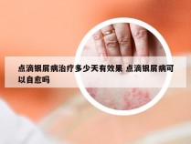 点滴银屑病治疗多少天有效果 点滴银屑病可以自愈吗