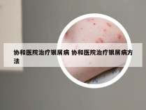 协和医院治疗银屑病 协和医院治疗银屑病方法