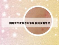 图片有牛皮癣怎么清除 图片含有牛皮
