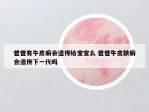 爸爸有牛皮癣会遗传给宝宝么 爸爸牛皮肤癣会遗传下一代吗