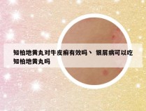 知柏地黄丸对牛皮癣有效吗丶 银屑病可以吃知柏地黄丸吗