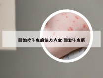 醋治疗牛皮癣偏方大全 醋治牛皮屑