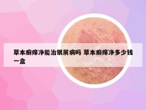 草本癣痒净能治银屑病吗 草本癣痒净多少钱一盒