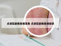 点滴型副银屑病发展 点滴型副银屑病症状