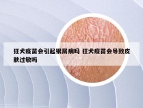 狂犬疫苗会引起银屑病吗 狂犬疫苗会导致皮肤过敏吗