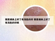 银屑病身上好了有浅色的印 银屑病身上好了有浅色的印痕
