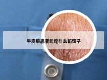 牛皮癣患者能吃什么馅饺子