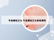牛皮癣吃三七 牛皮癣吃三七粉有用吗