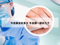 牛皮癣会长多少 牛皮癣一般长几个