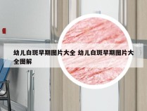 幼儿白斑早期图片大全 幼儿白斑早期图片大全图解