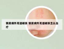 银屑病外耳道破损 银屑病外耳道破损怎么治疗