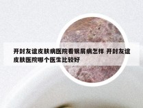 开封友谊皮肤病医院看银屑病怎样 开封友谊皮肤医院哪个医生比较好