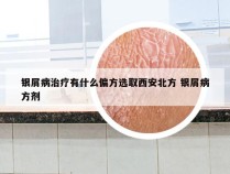 银屑病治疗有什么偏方选取西安北方 银屑病方剂