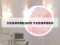 牛皮屑病早期能治好吗 牛皮屑病早期症状