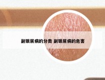 副银屑病的分类 副银屑病的危害