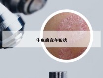 牛皮癣变车轮状