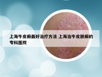 上海牛皮癣最好治疗方法 上海治牛皮肤癣的专科医院