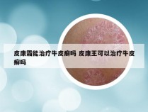 皮康霜能治疗牛皮癣吗 皮康王可以治疗牛皮癣吗