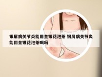 银屑病关节炎能用金银花泡茶 银屑病关节炎能用金银花泡茶喝吗