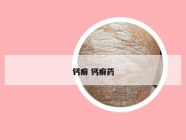 钙癣 钙癣药