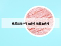 槐花能治疗牛皮癣吗 槐花治病吗