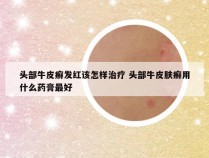 头部牛皮癣发红该怎样治疗 头部牛皮肤癣用什么药膏最好