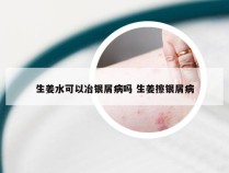 生姜水可以冶银屑病吗 生姜擦银屑病