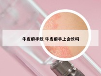 牛皮癣手纹 牛皮癣手上会长吗