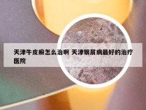 天津牛皮癣怎么治啊 天津银屑病最好的治疗医院