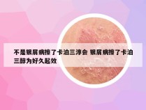 不是银屑病擦了卡泊三淳会 银屑病擦了卡泊三醇为好久起效