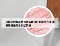 皮肤上的银屑病有什么比较好的治疗方法 皮肤银屑是什么引起的病
