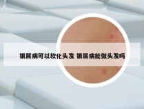 银屑病可以软化头发 银屑病能做头发吗