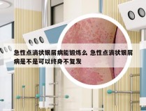 急性点滴状银屑病能锻炼么 急性点滴状银屑病是不是可以终身不复发