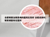 合肥哪里治银屑病的医院比较好 合肥皮肤科银屑病最有名医院