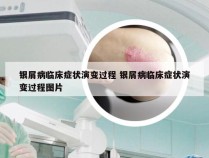 银屑病临床症状演变过程 银屑病临床症状演变过程图片