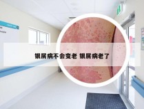 银屑病不会变老 银屑病老了