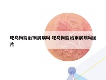 吃乌梅能治银屑病吗 吃乌梅能治银屑病吗图片