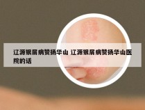 辽源银屑病赞扬华山 辽源银屑病赞扬华山医院的话