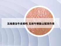 五维康治牛皮癣吗 五维牛磺酸口服液作用