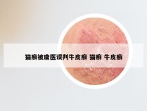 猫癣被庸医误判牛皮癣 猫癣 牛皮癣