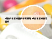 成都的银屑病医院哪家最好 成都银屑病推荐医院