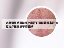 太原银屑病医院哪个最好的医院是哪家好 太原治疗银屑病哪家最好
