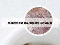 银屑病的中药泡澡 银屑病中药泡澡配方