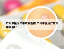 广州中医治疗牛皮癣医院 广州中医治疗皮炎哪家最好
