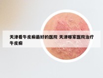 天津看牛皮癣最好的医院 天津哪家医院治疗牛皮癣