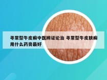 寻常型牛皮癣中医辨证论治 寻常型牛皮肤癣用什么药膏最好