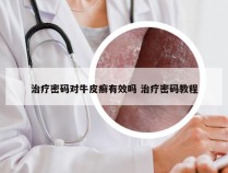 治疗密码对牛皮癣有效吗 治疗密码教程