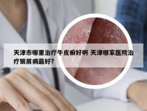 天津市哪里治疗牛皮癣好啊 天津哪家医院治疗银屑病最好?